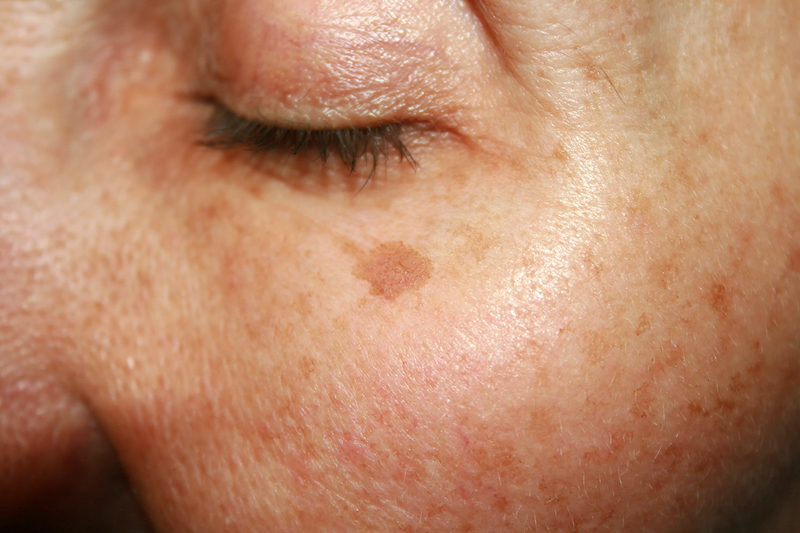 Age Spots & Pigmentation - Laser Skin Care