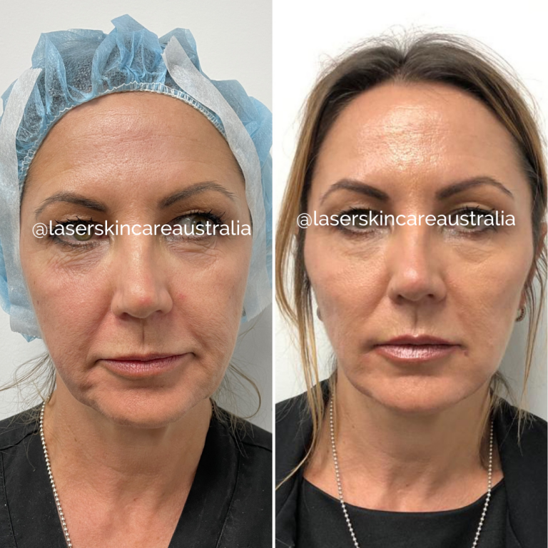 Thread Lift Procedure Laser Skin Care